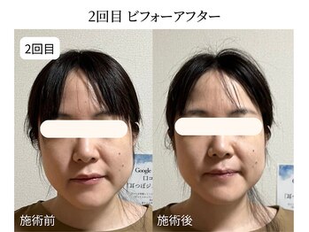 ドリームスパ 武蔵小杉店(DREAM SPA)/小顔before→after
