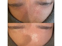 ラドンナ(LA DONNA)/フラクショナル×サーマル