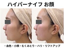 サロンイーエフ セントラル店(Salon EF)/ハイパーナイフ/全顔