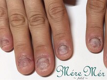 メールメール 和光市本店(MereMer)/（開始）110 深爪 深爪緩和 ケア