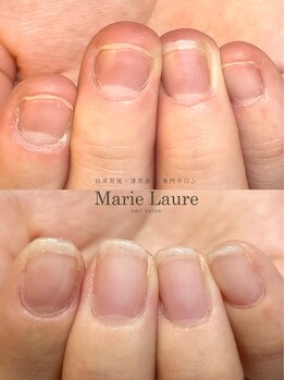 マリーロール 梅田店(Marie Laure)/自爪育成/深爪矯正/ネイルケア