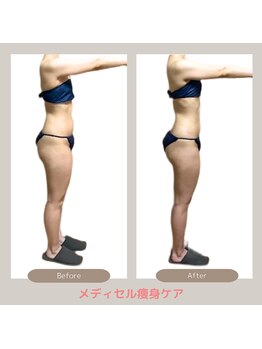 トレゾアスィス(Tresor sis)/痩身/ダイエット/筋膜リリース