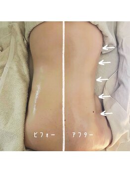 エン ボディアンドフェイシャル(En)/ハイパーナイフ・上半身5回/痩身