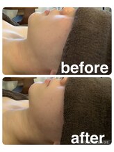 ギンザアール(GINZA R.)/小顔ケア♪