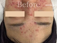 フェイシャルヴィム(FACIAL VIM)/肌荒れは根本改善が大切