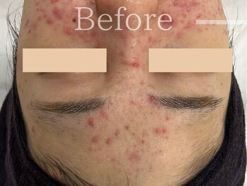 フェイシャルヴィム(FACIAL VIM)/肌荒れは根本改善が大切