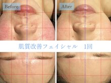 リテルナ(Re.terna)の雰囲気（1度でこの効果!!目に見える効果をご実感ください。肌質改善）