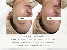 エメ(aimer)/LiftCare《小顔・リフトアップ》