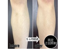 ナインズ(nines)/下半身脱毛(ももからつま先)