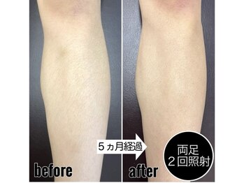 ナインズ(nines)/下半身脱毛(ももからつま先)