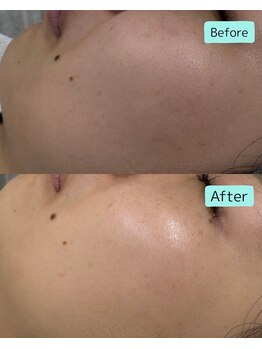 マーレ(MARE)/ララピール×フルケア