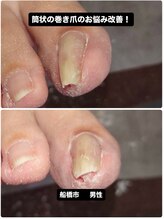 巻き爪じゅん 千葉駅前店/【要注意】巻き爪が筒状に変形！