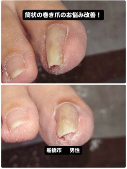 【要注意】巻き爪が筒状に変形！