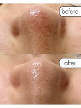 マーレ(MARE)/話題の毛穴洗浄！