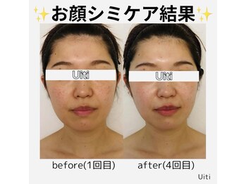 アルティ バイ ドルチェ(Ulti by dolce)/シミケア♪