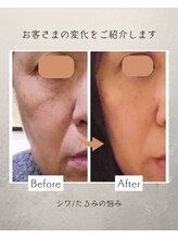 コーヴォ(COVO)/【たるみに！頬の引上げfa】