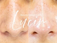 ルシール 仙台店(lucir)/<毛穴洗浄> Before/After