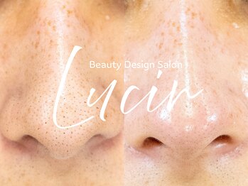 ルシール 仙台店(lucir)/<毛穴洗浄> Before/After