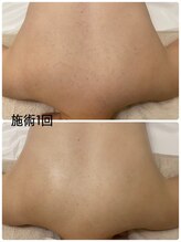 アミリー(A'mily)/背中ハーブBeforeAfter