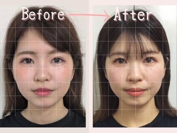 ビーレ袋町/[小顔矯正]更に綺麗に、可愛く