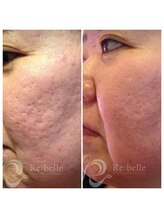 エヌ スタイル(N Style)/リベルハーブピーリング 