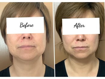 ビューティフルムーン(Beautiful Moon)/小顔矯正&全身骨格矯正♪