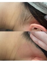 ミリプラス(MiLi +)/うなじ/襟足/産毛