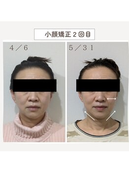 ミヤビ(miyabi)/小顔矯正