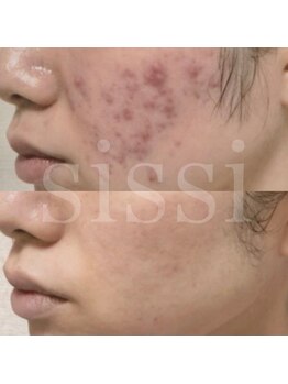 シシィ 二子玉川(sissi)/ニキビケア