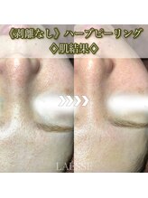 ラエッセ(LAESSE)/ハーブピーリングの肌結果！！