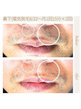 エスト(Est_.)/美容電気脱毛【光脱毛残り毛】