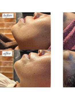 ラローズ(La Rose)/韓国シワたるみケア★サーマガン