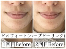 フルール(FLEUR)/ビオフィート/ハーブピーリング