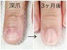 深爪緩和コース（爪の白い部分が無い方）ホームケア2点付　¥14,500