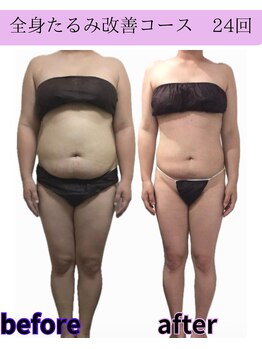 リラ(Lilas)/【痩身】たるみ改善全身コース