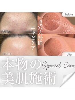 ラ ミュー エステハウス 伊勢店/ニキビケア・毛穴洗浄・肌管理