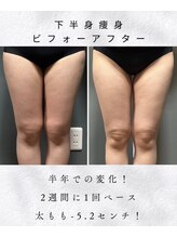 アシュレ リル(assure Lilou)/【痩身】Before→After