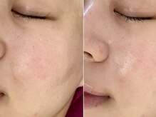 バタフライ 津田沼店(Butterfly)/Butterflyのハーブピーリング