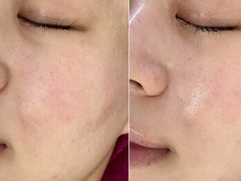 バタフライ 津田沼店(Butterfly)/Butterflyのハーブピーリング