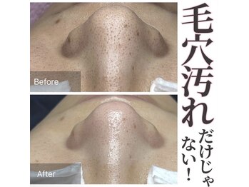 癒える(ielu)/毛穴エクストラクション★BA