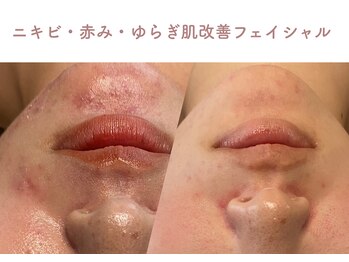 エステティックサロン シーズ/ゆらぎ肌を肌改善　4回の効果