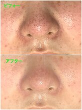 ザ ファーストサロン(The First Salon)/美白コースで毛穴ケア