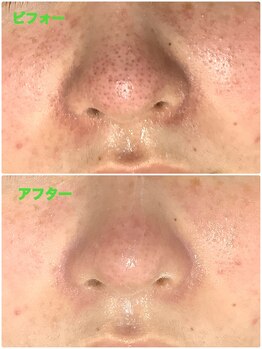 ザ ファーストサロン(The First Salon)/美白コースで毛穴ケア