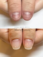 マリーロール 梅田店(Marie Laure)/自爪育成/深爪矯正/ネイルケア