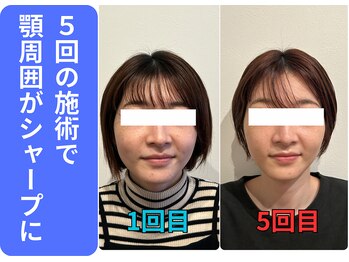 広島ミライエ整体院(広島MIRAIE整体院)/5回でリフトアップ