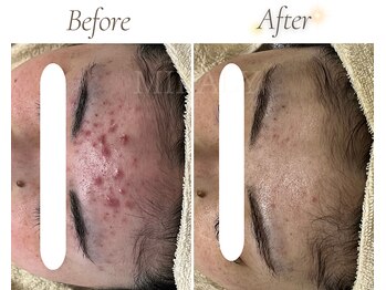 ミラリー(MIRALY)/おでこニキビケア5ヶ月(20代)