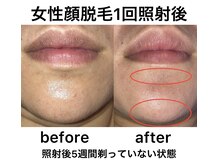 リノ(Lino)/レディース　顔脱毛☆