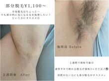 部分脱毛ができるサロン◎\1,100～