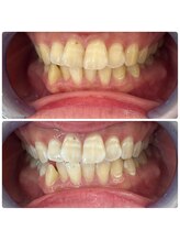 グリッター ショウナン(glitter. SHONAN)/藤沢ホワイトニングbefore/after