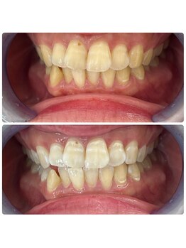 グリッター ショウナン(glitter. SHONAN)/藤沢ホワイトニングbefore/after